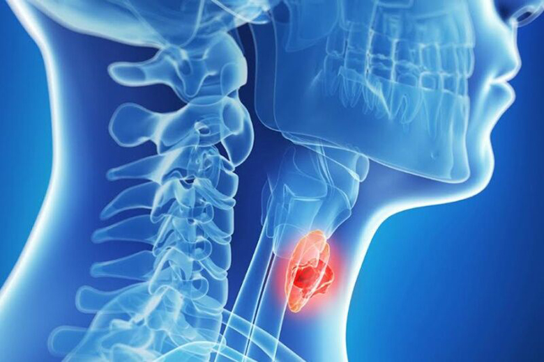 عکس خبري - هر آنچه درباره گره يا ندول تيروئيد بايد بدانيد