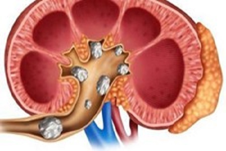 عکس خبري - مبتلايان به «سنگ کليه» چي بخورند؟