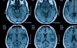 عکس خبري -کرونا منجر به کوچک شدن مغز و آسيب به بافت‌هاي آن مي‌شود