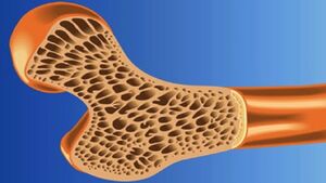 عکس خبري -درمان پوکي استخوان با فناوري نانو