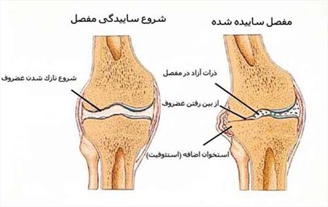 عکس خبري -خوردن اين غذاها آرتروز را درمان مي کند!