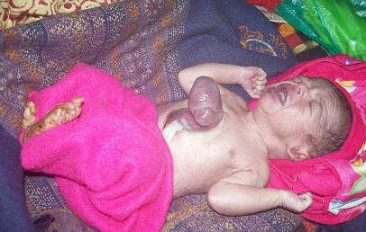 عکس خبري -تولد نوزاد هندي با قلب خارج از بدن + عکس