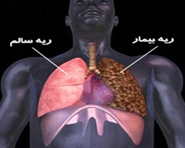 عکس خبري -سرطان ريه بو دارد