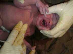 عکس خبري - تولد نوزاد خارق‌العاده در قم!
