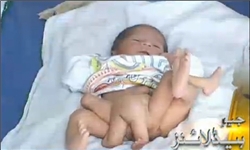 عکس خبري -يك نوزاد 6 پا در پاكستان متولد شد+عكس