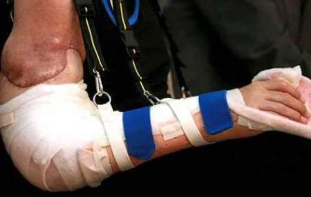 عکس خبري - معلول هندي با جراحي پيوند صاحب دو دست شد