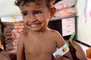 عکس خبري -افزايش نگران‌کننده سوء تغذيه حاد در ميان کودکان يمني