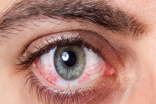 عکس خبري - به تعويق انداختن درمان کدام يک از بيماري‌هاي چشمي خطرناک است؟