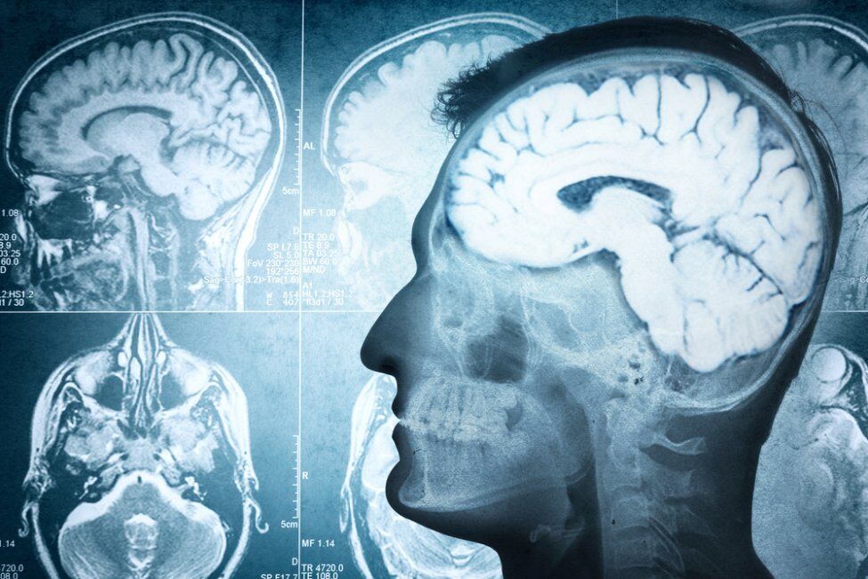 عکس خبري -آنتي بادي کليد درمان آلزايمر و سکته مغزي