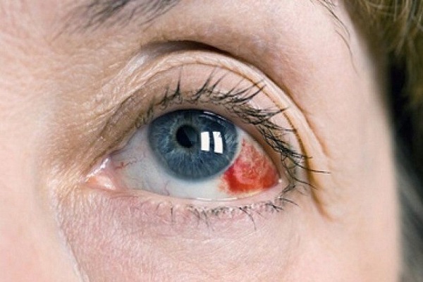 عکس خبري - لکه هاي قرمز داخل چشم چه رازهايي درباره سلامت شما دارند؟