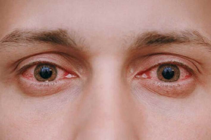 عکس خبري - دلايل اصلي قرمزي چشم چيست؟ + درمان